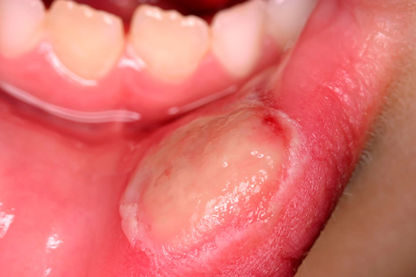 внешний вид стоматита на губе