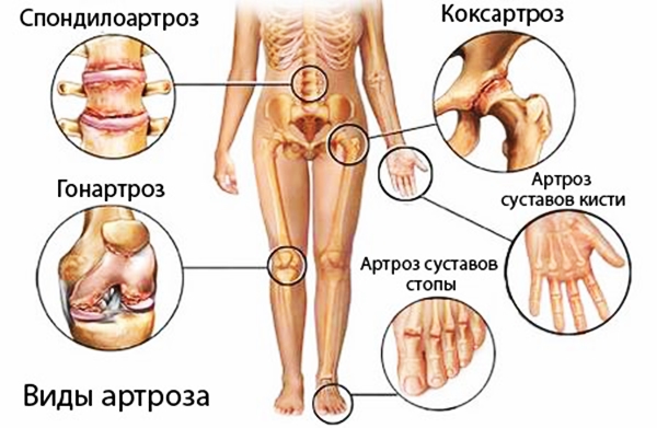 Изображение - Лечение суставов имбирем рецепты artroz-foto2